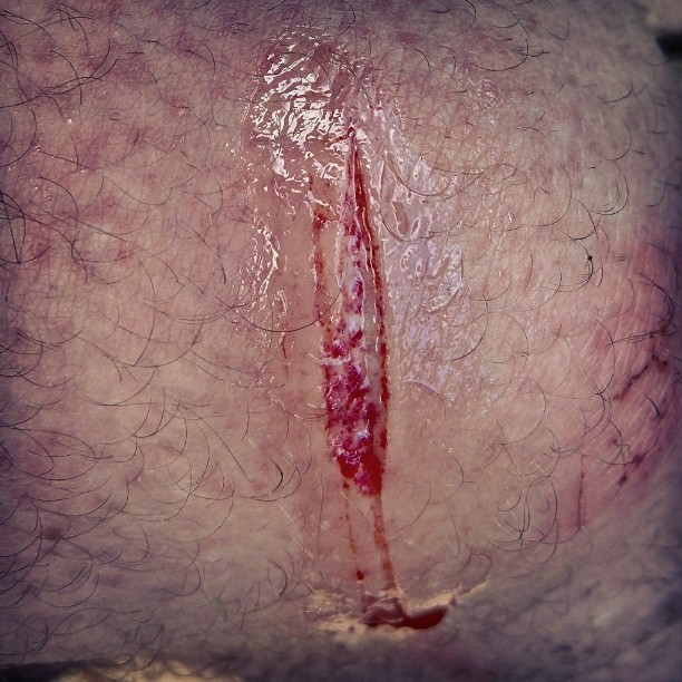 The #Hawaiian #ocean #attacked me again. :) #Coral #deepcut #knee